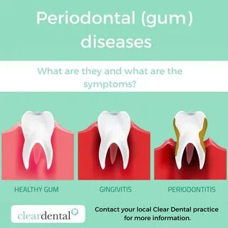 Periodontal (gum) diseases - Clear Dental.