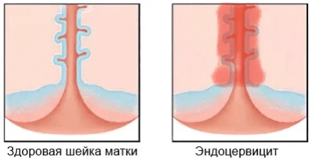 Эндоцервикс признаки. Заболевание эндоцервицит. Эндоцервицит шейки матки.