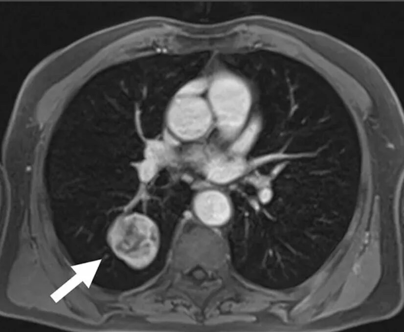 Опухоли средостения кт. Опухоль бронха кт с контрастированием. На кт видно опухоль