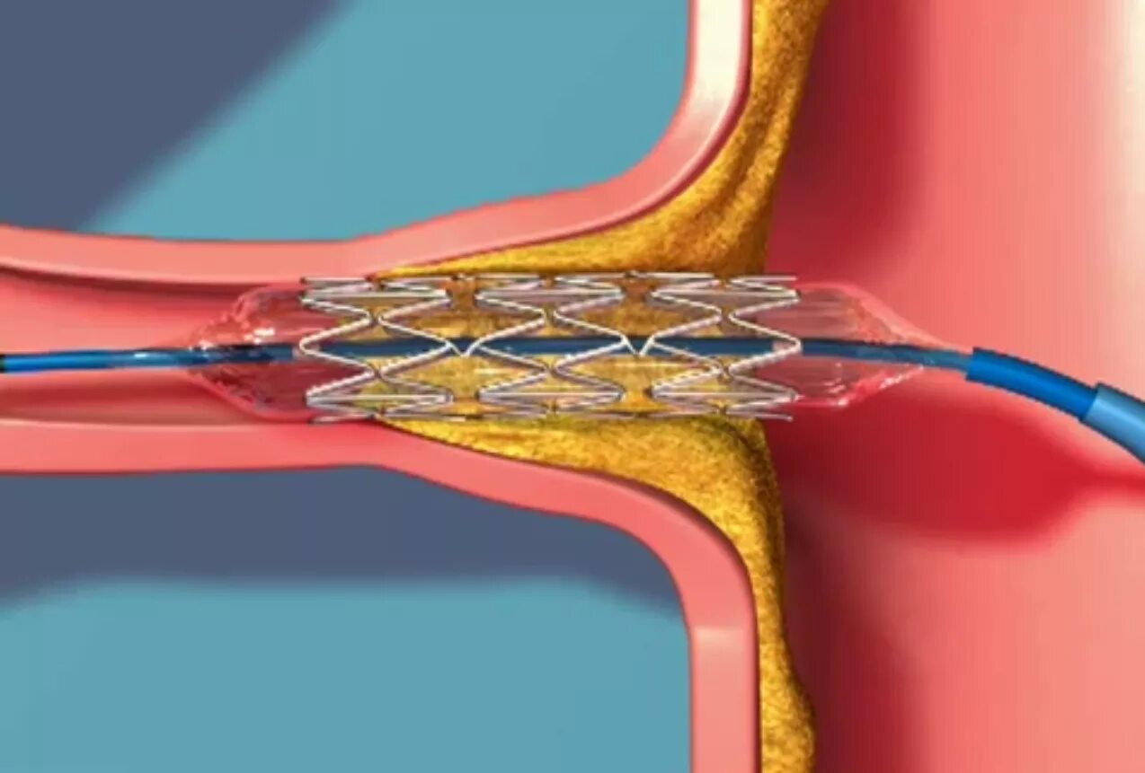 катетер стент почечный. моче стент. стент урологический мочеточниковый. катетер стент мочеточниковый.