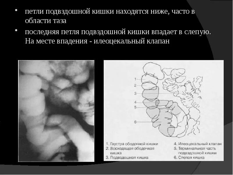 Подвздошная кишка. Термальный отдел подвздошной кишки схема. Дистальный отдел подвздошной кишки. Терминальный отдел подвздошной кишки. Петли подвздошной кишки.