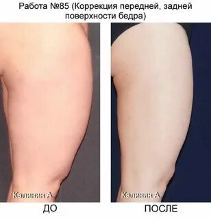 Отек внутренней стороны бедер
