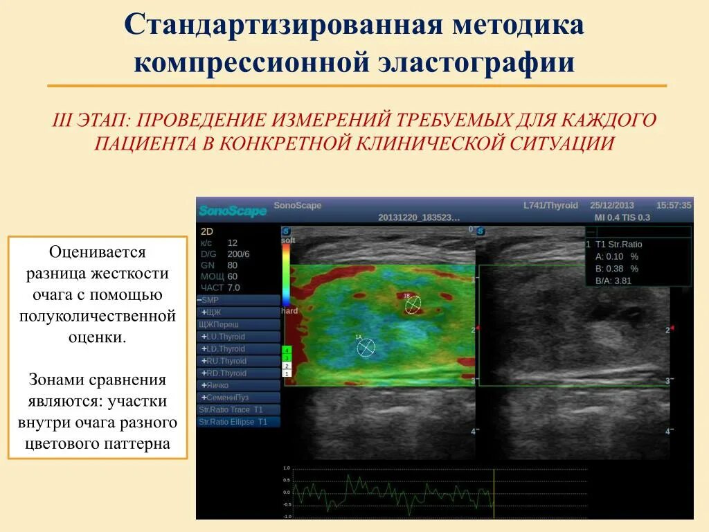 Компрессионная эластография щитовидной железы. Эластография протокол УЗИ. Эластография щитовидной железы протокол УЗИ. Эластография молочной железы протокол.