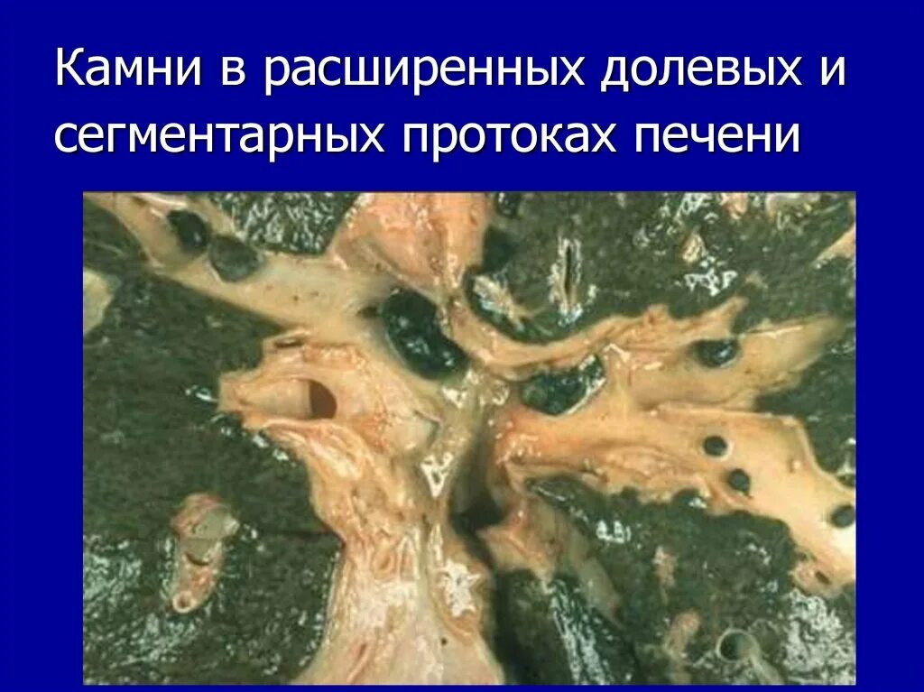 Камни в протоке печени. Камень в печеночном протоке. Камни в прокаках печени. Камень в долевом протоке.