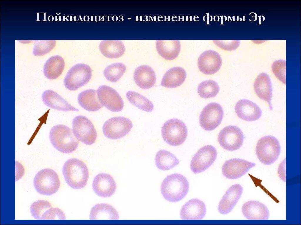 Пойкилоцитоз анемия. Пойкилоцитоз. Пойкилоцитоз формы. Анизоцитоз и пойкилоцитоз.