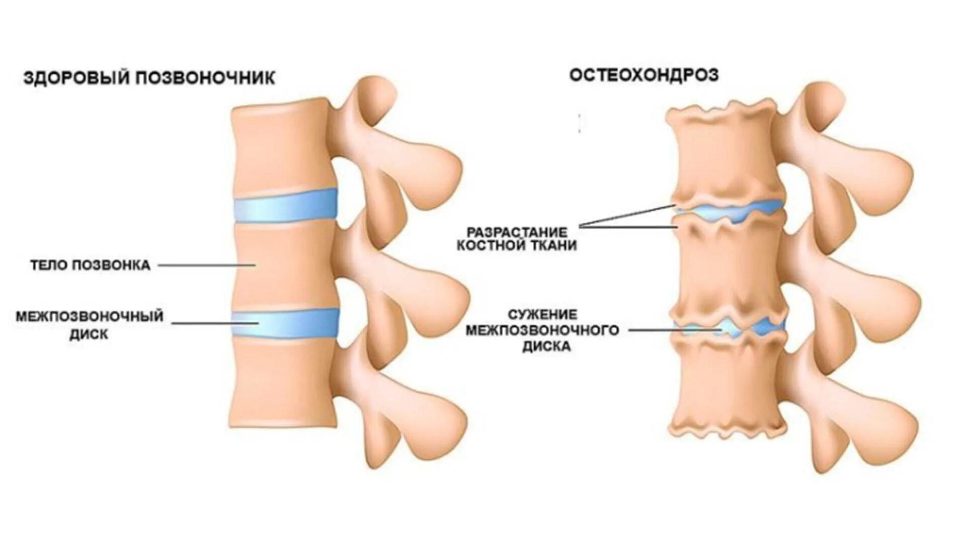 Позвонки и межпозвоночные диски остеохондроз. Межпозвоночный диск при остеохондрозе. Остеохондроз поясничного отдела схема. Остеохондроз шейного и поясничного отдела позвоночника.