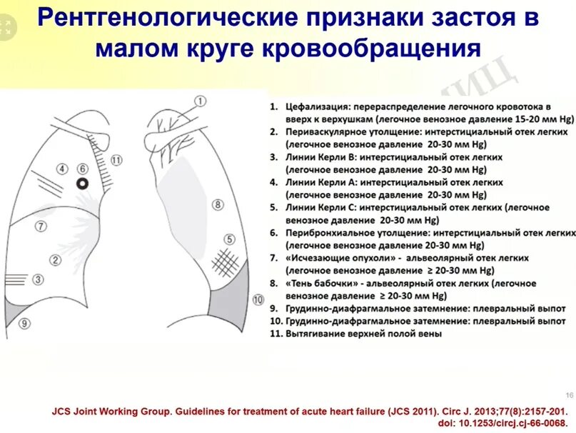 Застой по малому кругу. Рентгенологические признаки застоя в Малом круге кровообращения. Застой в Малом круге. Рентген признаки застоя в Малом круге. Признаки застоя в Малом круге.