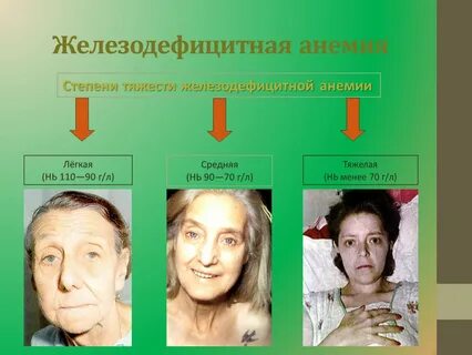 Признаки легкой анемии у женщин