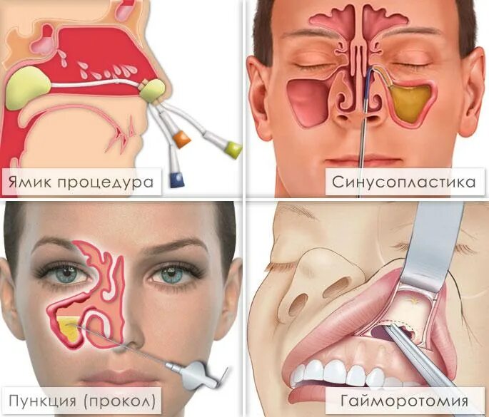 Сколько лечат гайморит