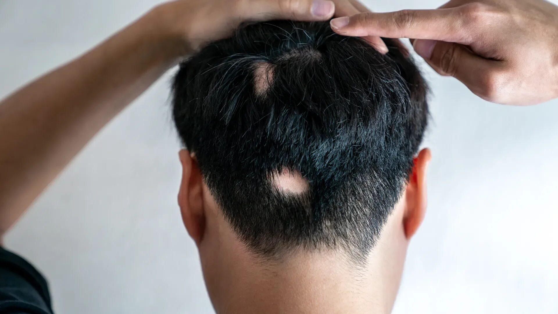 Причину выпадения волос после 40. Зоны облысения у мужчин.