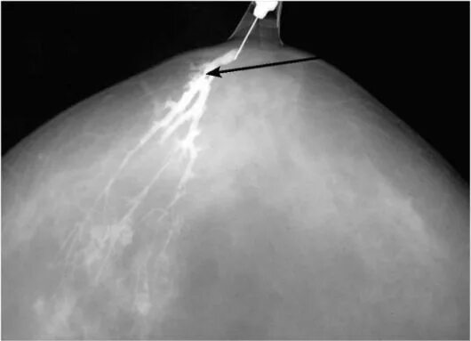 Папиллома протоков молочной железы. Внутрипротоковая папиллома дуктография. Внутрипротоковая папиллома молочной железы дуктография. Внутрипротоковая папиллома маммография. Маммография дуктография.
