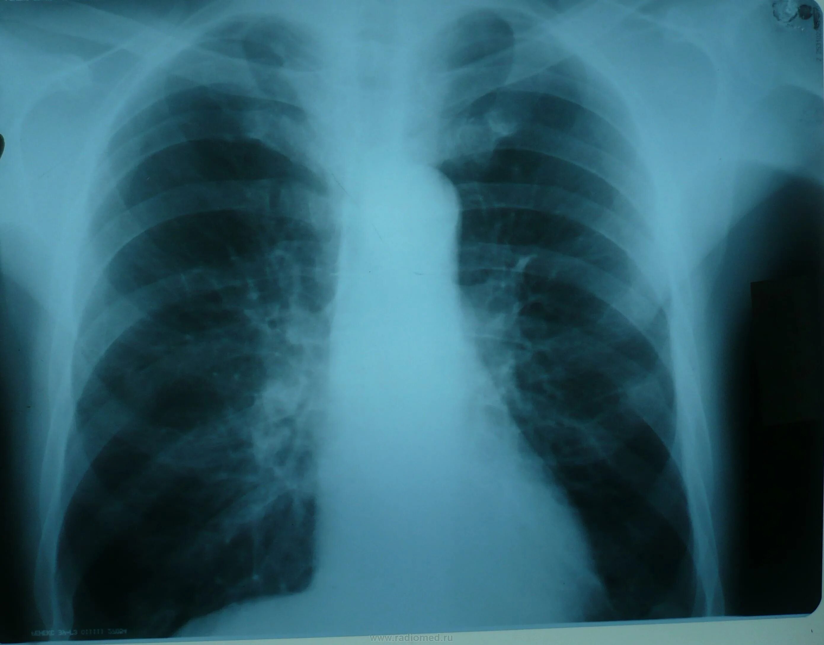 Очаговая форма туберкулеза. Очаговый туберкулез рентген. Туберкулез легких рентген. Очаговый туберкулез легких рентген снимки. Легочный туберкулез очаговый снимок рентген.