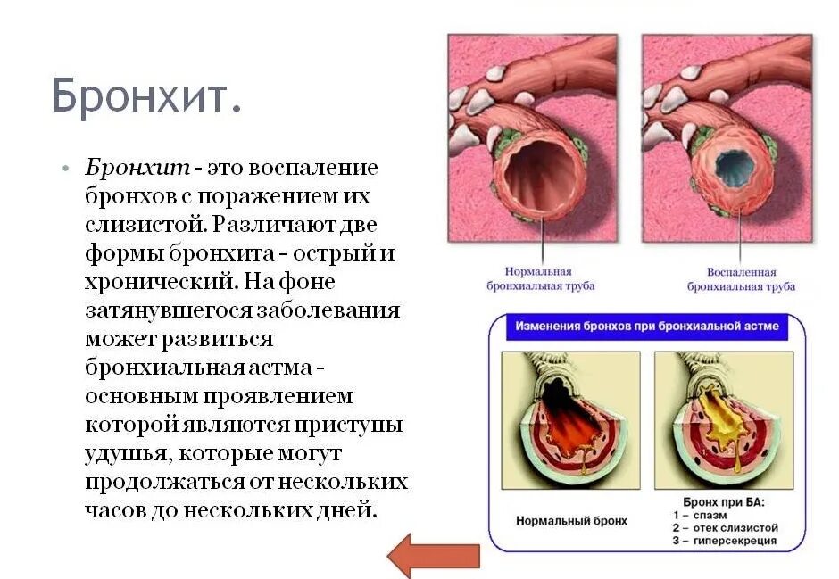 Описание бронхита