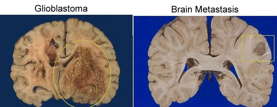 Злокачественная глиобластома головного мозга. Макропрепарат глиома головного мозга. Опухоль мозга глиобластома. Глиобластома левой теменной доли.