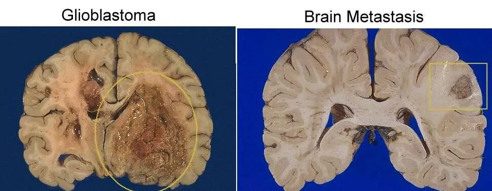 Глиобластома сколько живут. Злокачественная глиобластома головного мозга. Макропрепарат глиома головного мозга. Опухоль мозга глиобластома. Глиобластома левой теменной доли.