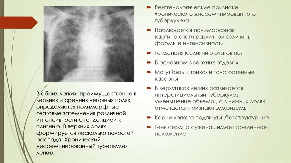 Рентген признаки хронического диссеминированного туберкулеза. Подострый диссеминированный туберкулез рентген. Диссеминированный туберкулез в стадии распада. Диссеминированный туберкулез в фазе распада.