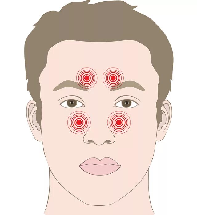Болят брови и лоб. Хиджама при гайморите точки. Хиджама точки гайморита.