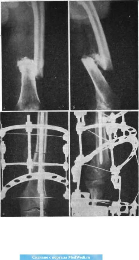 Оскольчатый перелом диафиза бедренной кости. Остеосинтез внутрикостный (1 / 2 категория). Ложный сустав диафиза бедра. Оскольчатый перелом рентген. Перелом без операции срастется