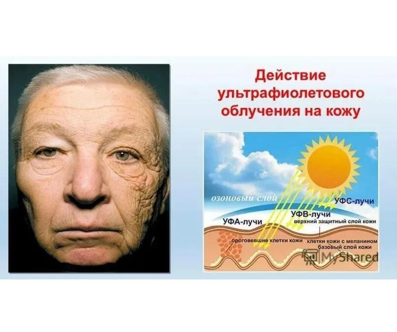 Солнце действие. Влияние ультрафиолета на кожу. Воздействие УФ излучения на кожу. Воздействие УФ лучей на кожу. Влияние на кожу УФ излучение.