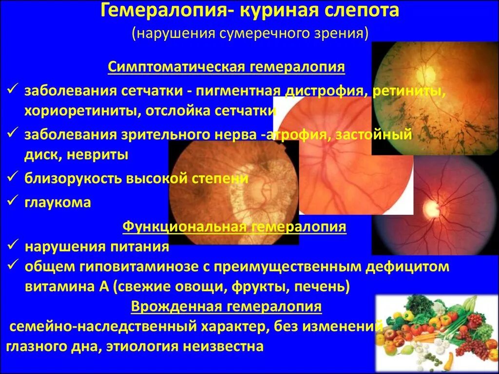 Заболевание куриная слепота витамины. Нарушение сумеречного зрения. Куриная слепота — расстройство сумеречного зрения.. Растройсовсумеречного зрения. Симптоматическая гемералопия.