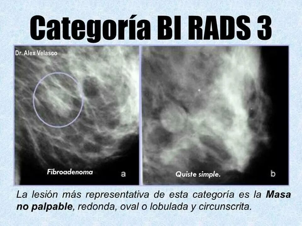 Фиброаденоматоз bi. Маммография bi-rads 4. Маммография молочных желез bi rads 4. Фиброзно кистозная мастопатия молочной железы bi-rads-4a. Bi-rads 3 молочной железы маммограмма.