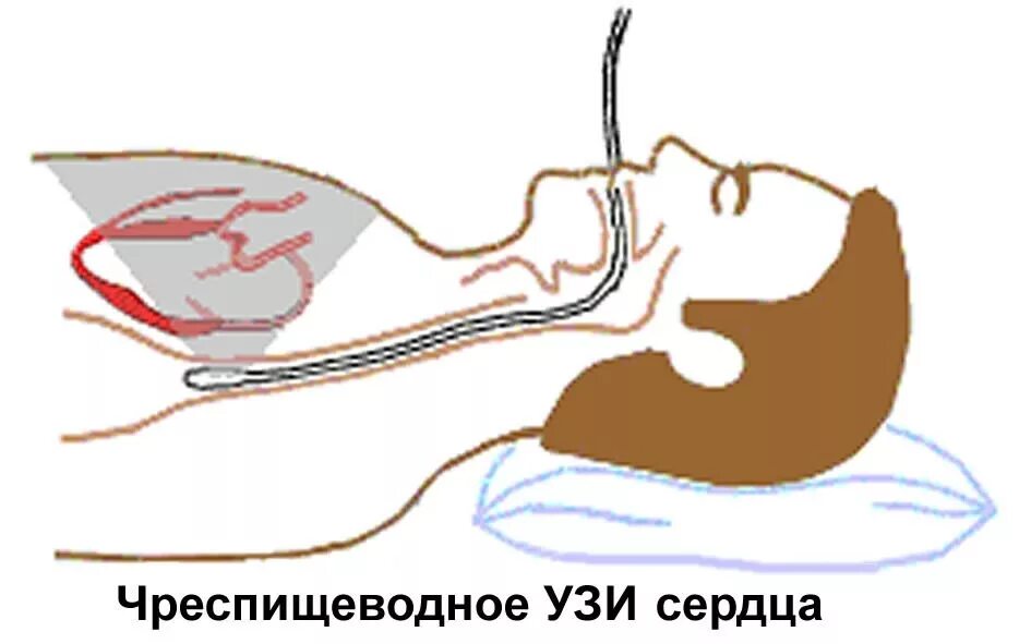 Как проходят эхо. Чреспищеводная эхокардиография ЧПЭХОКГ. Чреспищеводная электростимуляция. Эхокардиография через пищевод. Чреспищеводная электрокардиостимуляция сердца.