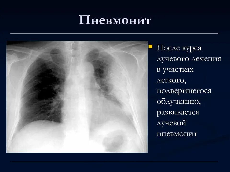 Радиационный пневмонит. Радиационная пневмония. Постлучевой пневмонит.