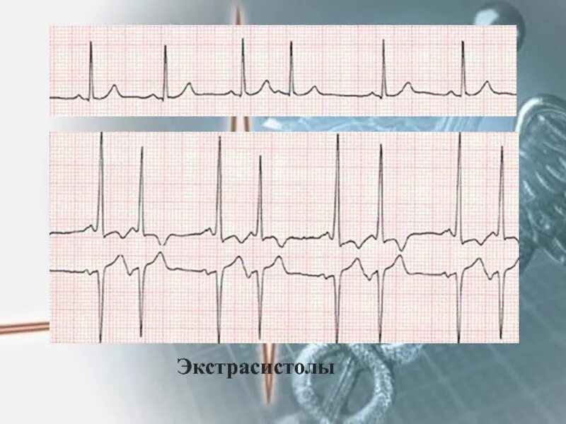 Экстрасистолы в положении лежа. Экстрасистолы лежа на животе. Экстрасистолы на левом боку. Экстрасистолы лежа