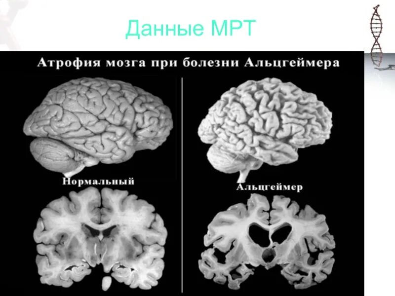 Проект альцгеймер. Проект альцгеймер. Болезнь альцгеймера тип 1. Болезнь альцгеймера презентация. Болезнь альцгеймера мутация.