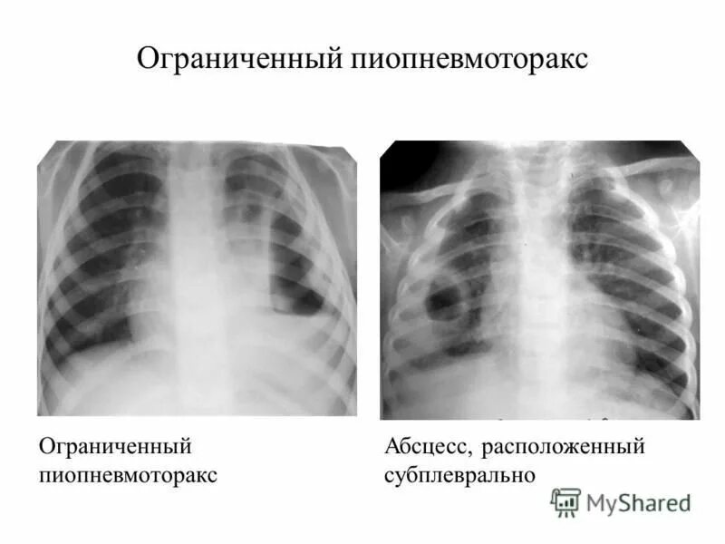 Субплевральные отделы легких