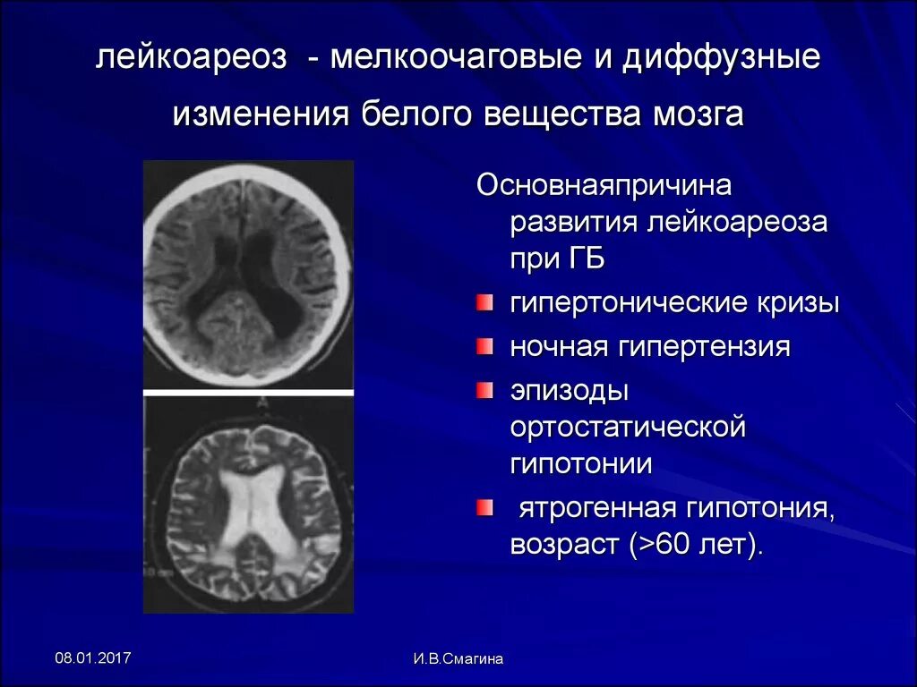 Лейкоареоз RN. Лейкоарахиоз головного мозга. Перивентрикулярный лейкоареоз на кт. Лейкоареоз на кт. Что означает очаговое изменение мозга