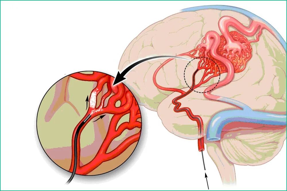 Тромбоз артерии мозга. Эмболизация АВМ сосудов головного мозга. АВМ мальформация сосудов головного мозга. Эмболизация мальформации. Артериовенозные мальформации сосудов головного мозга.