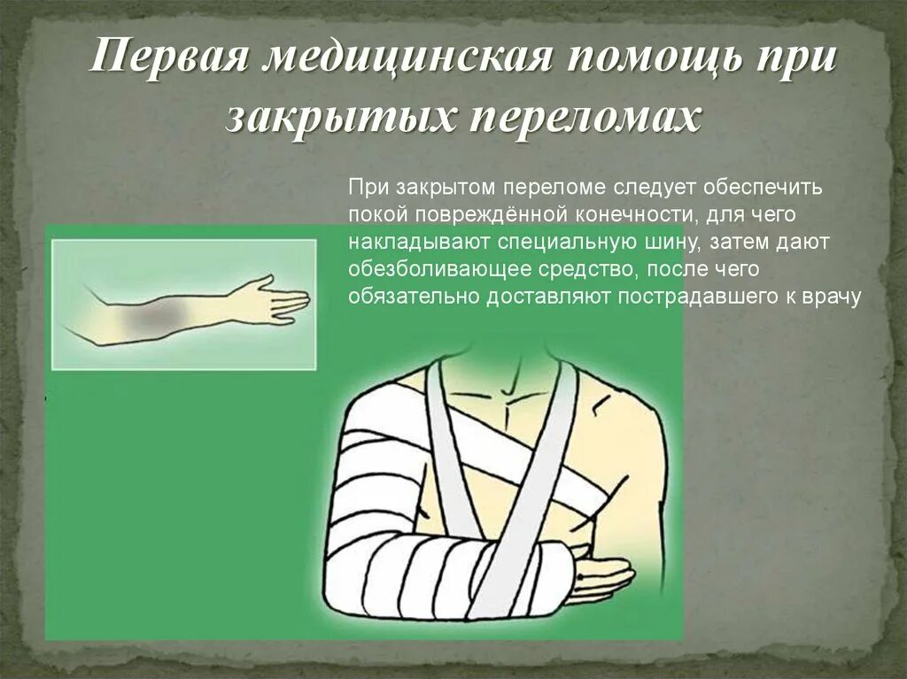 1 первая помощь при травмах. Первая мед помощь при травмах и повреждениях. первая медицинская помощь при переломах. первая помощь при закрытых переломах. повязка при закрытом переломе.