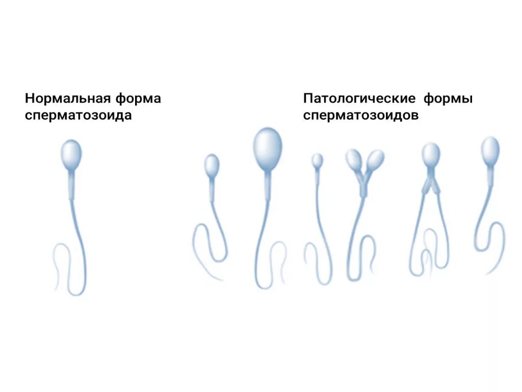 Женские спермии. Патология сперматозоидов. Здоровые сперматозоиды. Сперматозоиды неправильной формы. Как выглядит сперматозоид.