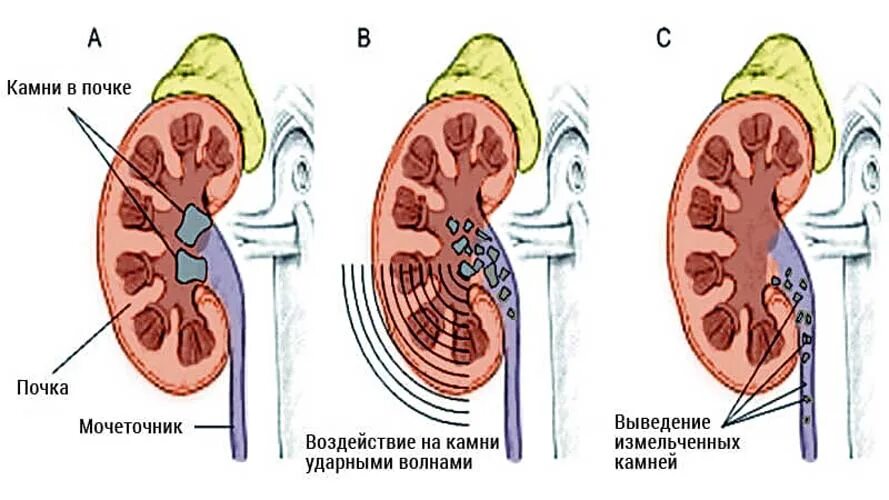 Мочекаменная болезнь мочеточника. Почечнокаменная болезнь камни. Мочекаменная болезнь камень лоханки левой почки. Дистанционная ударно-волновая литотрипсия камней почек. Мочекаменная болезнь литотрипсия.