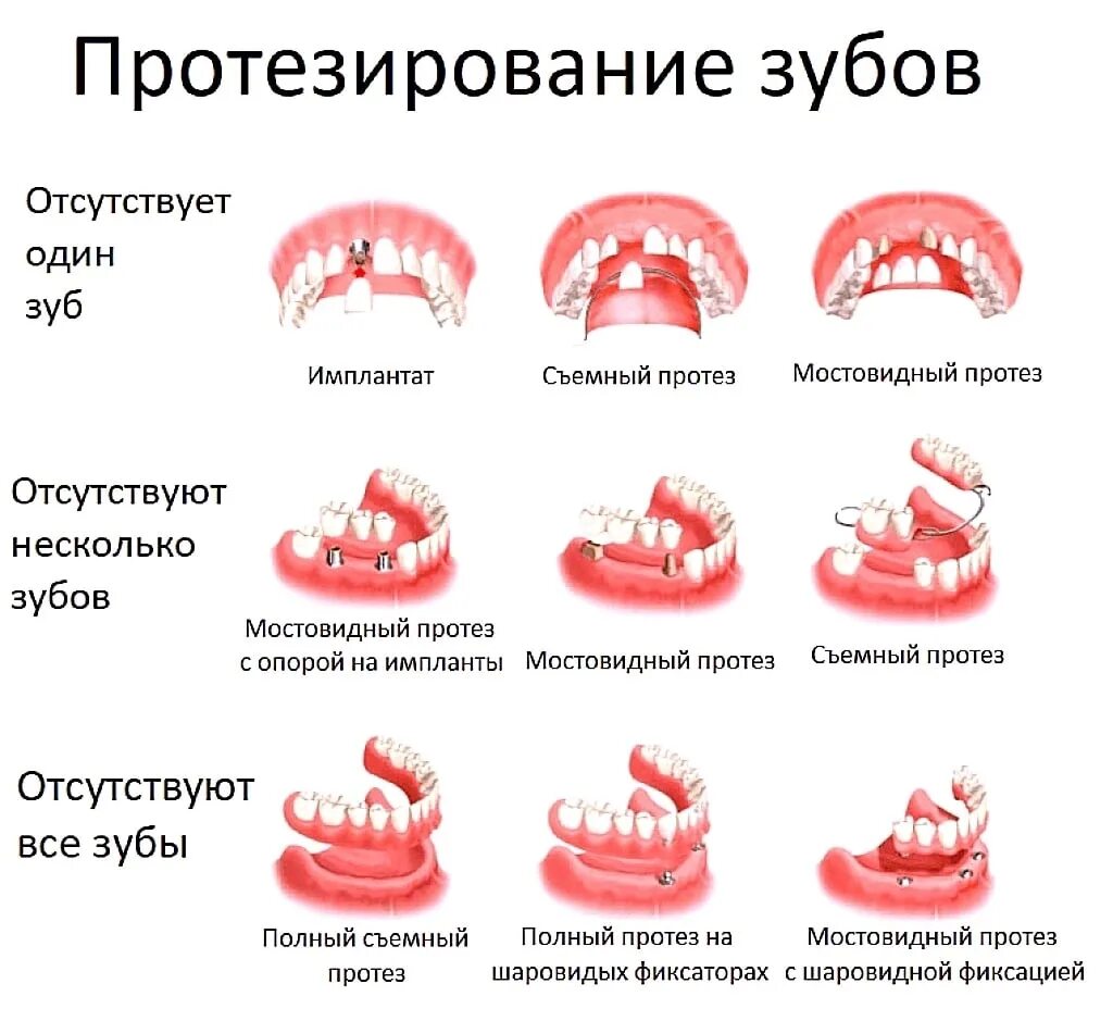 В какие дни удалять зубы. Классификация несъемных протезов ортопедическая стоматология. Какие виды съемных протезов бывают. Виды съемных конструкций зубных протезов. Классификация съемных протезов ортопедическая стоматология.