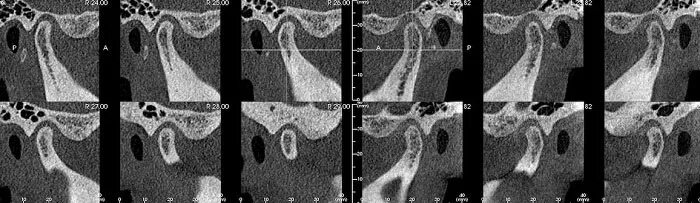 Артрит височно-нижнечелюстного сустава рентген протокол. Состпвная вголовка вннчс. Внчс норма. Деформирующий остеоартроз внчс рентген. Ревматоидный артрит внчс рентген.
