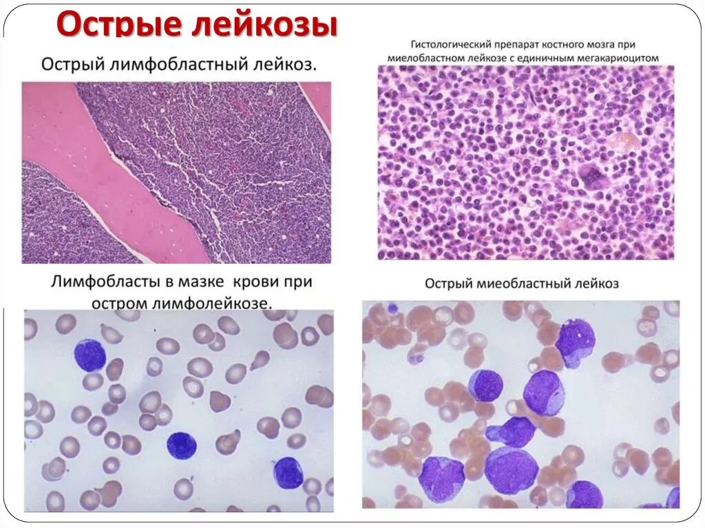 Мозг при остром лейкозе. Хронический миелобластный лейкоз гистология. Хронический миелобластный лейкоз костный мозг гистология. Острый миелобластный лейкоз препарат. Острый миелобластный лейкоз гистология.