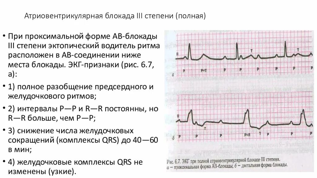 Атриовентрикулярная блокада симптомы