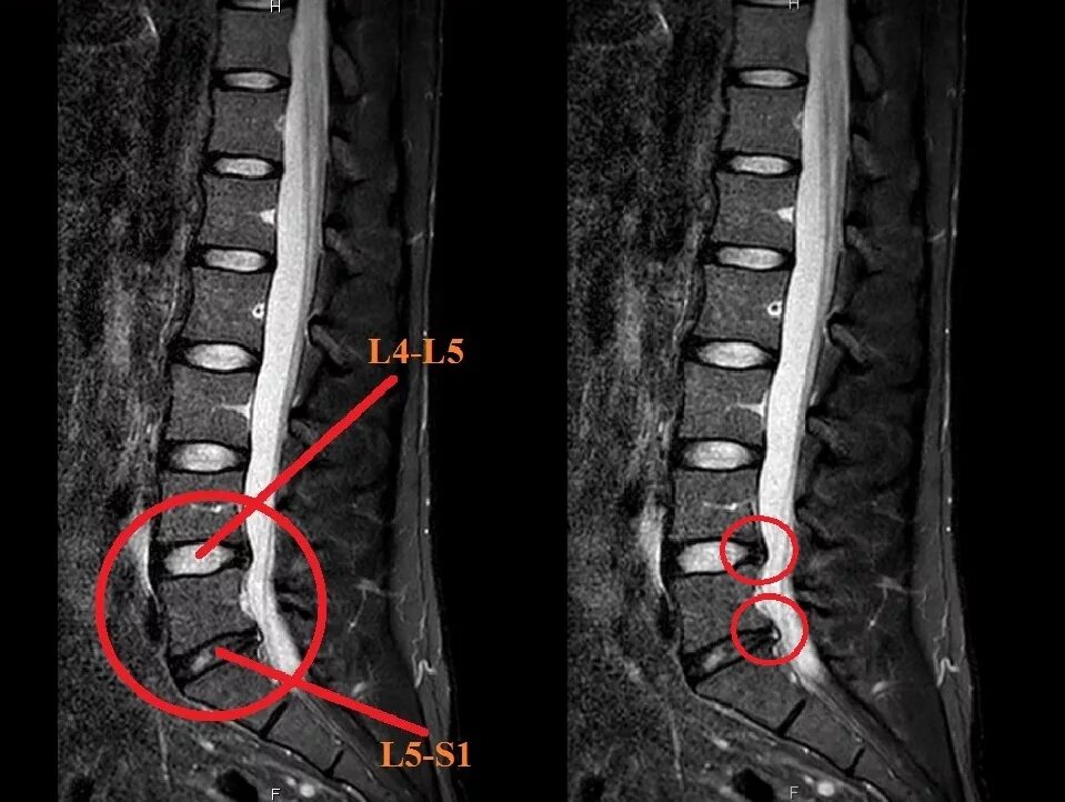 L5 s1 диск остеохондроз. Диски позвоночника l3-4, l5-s1. Протрузия l1-l4. Межпозвонковые диски l5-s1. Протрузия l1 l4 l5 s1 дисков.