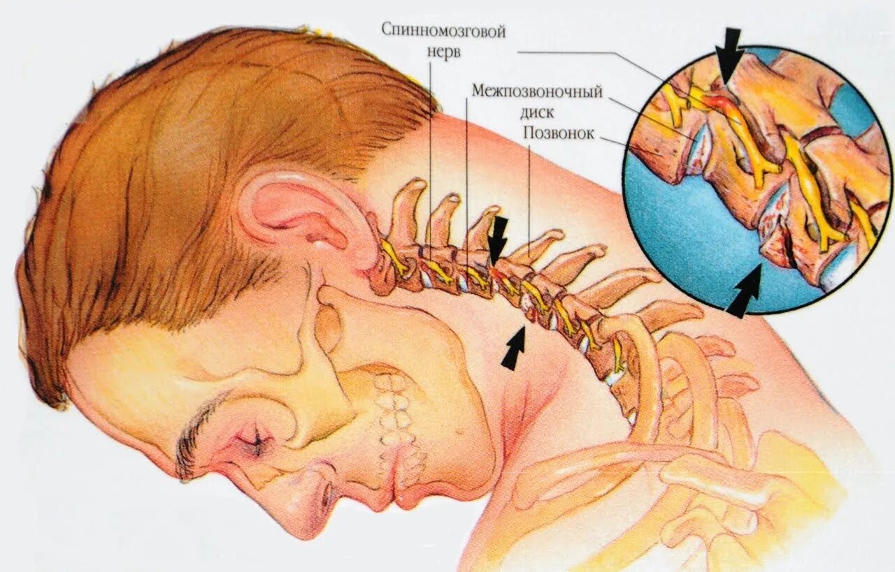 Остеохондроз шейного отдела. Защемление шейного нерва. Упражнения против головокружений при шейном остеохондрозе. Боли при повороте глаз