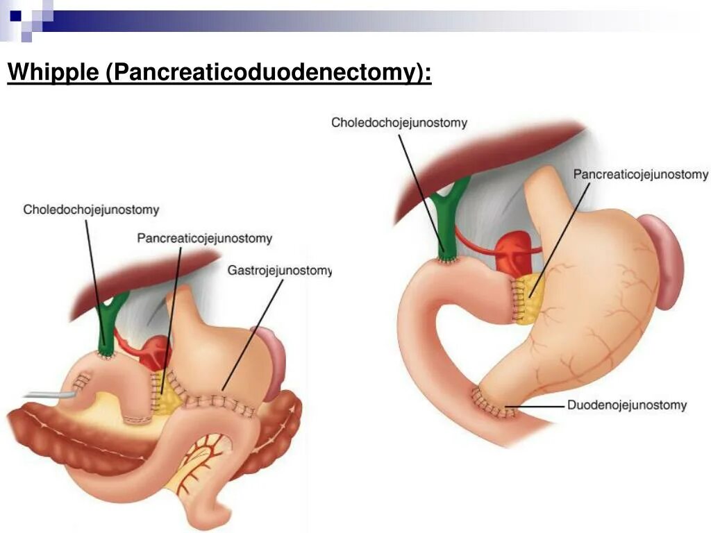 Операция Уиппла операция Уиппла. Операция Уиппла на поджелудочной железы.