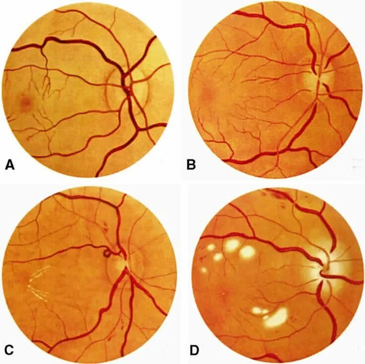 Гипертоническая ангиопатия сетчатки. Гипертоническая ретинопатия глазное дно. Ретинопатия Вальсальвы. Ангиопатия и ретинопатия сетчатки.