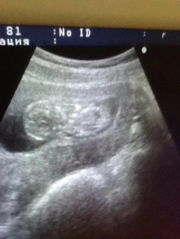 Скрининговые узи. 1 ый скрининг. Скрининговое узи при беременности. 1 скрининг при беременности патологии плода. 1 ый скрининг.
