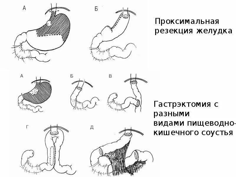 Умер от резекции желудка. Трубчатая резекция желудка. Резекция желудка по Бильрот 1. Пилоросохраняющая сегментарная резекция желудка.