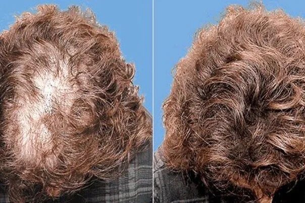 После химии выпадают. После химии выпадают волосы. Волосы после химии терапии. Волосы после хим завивки мужские. Хим завивка мужская до и после.