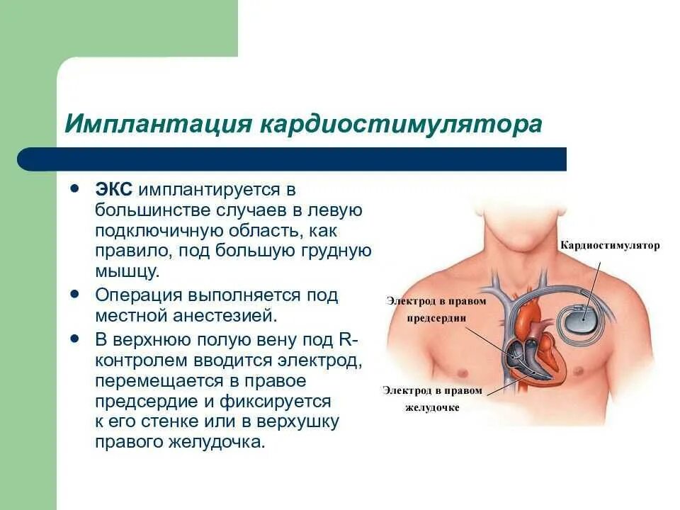 Имплантация кардиостимулятора. Установленный кардиостимулятор. Электрокардиостимулятора сердца. Почему в инструкции людям с кардиостимуляторами запрещается