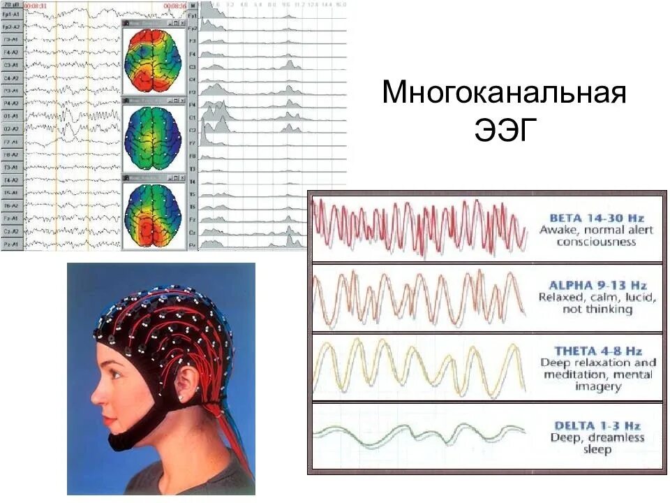 Электроэнцефалография головного мозга (ЭЭГ). ЭЭГ головного мозга методика проведения. ЭЭГ норма и патология. Вертексные потенциалы на ЭЭГ.