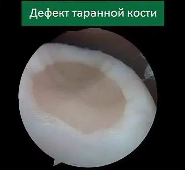 Повреждение хряща по outerbridge