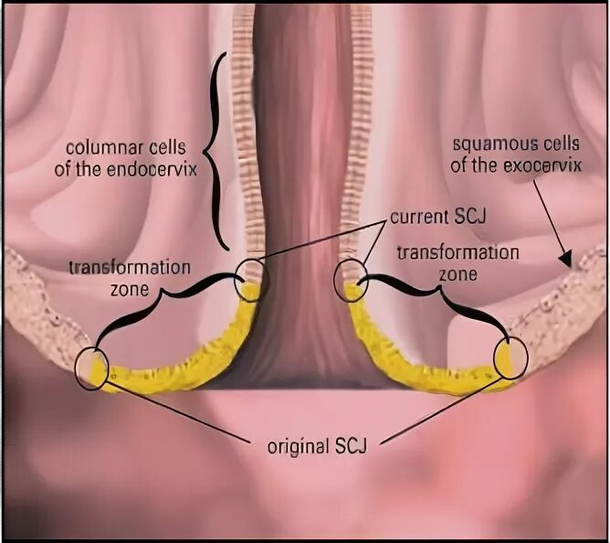 Зона трансформации шейки матки эпителий. Экзоцервикс и эндоцервикс что это. Цервикальный канал экзоцервикс. Изменения эндоцервикса